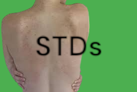 STDs